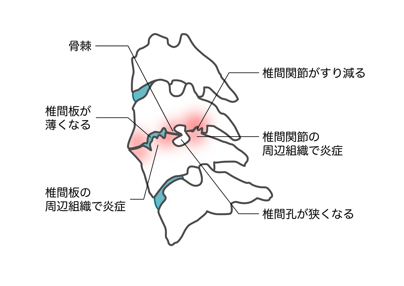 頸椎の椎間孔・神経根が通る孔の断面図