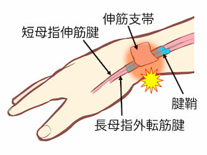 ドゥケルバン病・手首親指側の腱鞘炎部位の解剖図