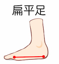 足のアーチが消失した偏平足の側面図