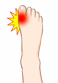 足の親指の付け根が赤く腫れて痛む痛風のイラスト