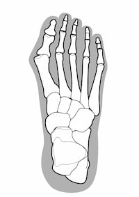 親指が小指側に曲がった外反母趾の足の骨格図