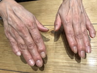 {指の第1関節が痛むへバーデン結節の症状と、治療に用いる漢方薬・桂枝加朮附湯（けいしかじゅつぶとう）}