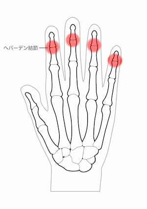 ヘバーデン結節・指関節が腫れた手の骨格図