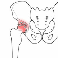 変形性股関節症・股関節の炎症部位を示す解剖図