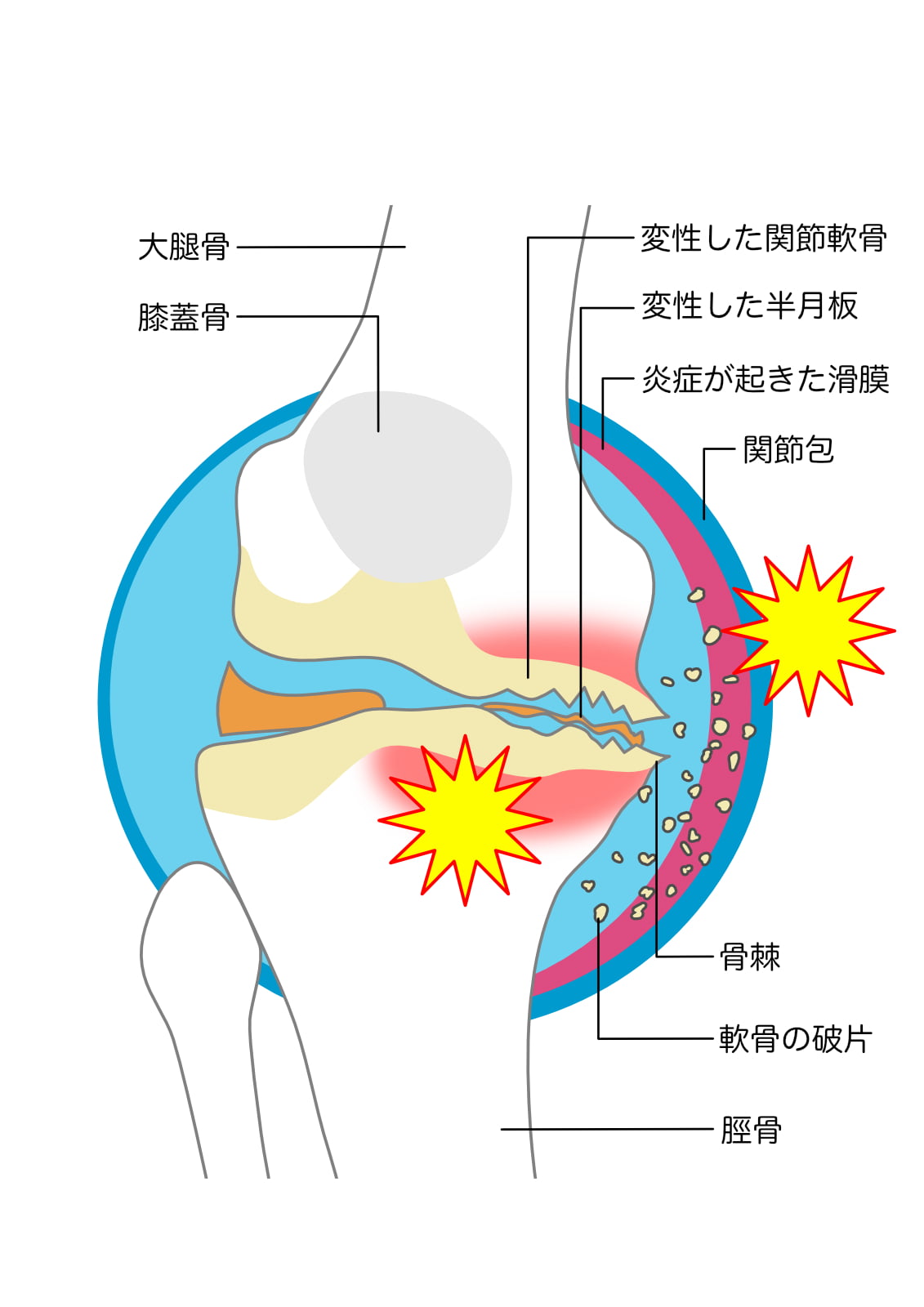 変形性膝関節症・軟骨がすり減った膝関節の断面図