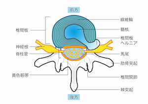 椎間板の中身が飛び出し神経を圧迫する腰椎椎間板ヘルニアの図