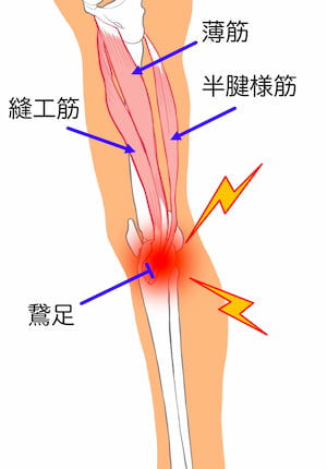 鵞足炎・膝内側の筋付着部を示す解剖図