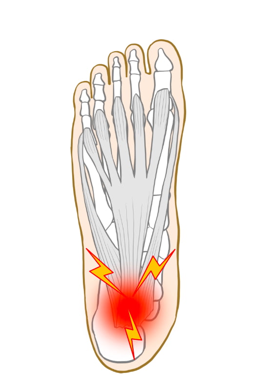 足底筋膜炎・足裏の炎症部位と腱の解剖図