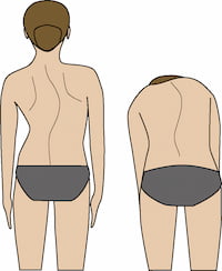 背骨が左右に曲がっている脊柱側弯症の背面イラスト